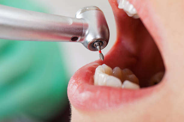 Best Emergency Tooth Extraction in Byron, IL